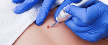 freeze pen therapy in Toronto to effective remove warts, skin tags and benign growths