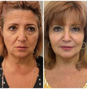 skin tightening treatment for face