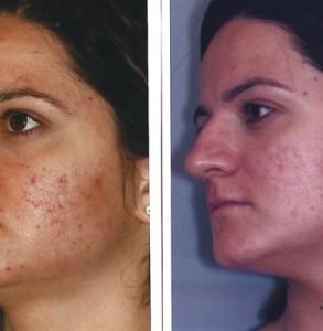 acnelan acne treatment toronto
