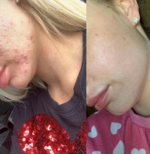 Acnelan acne treatment