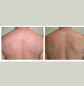 back hair removal with laser