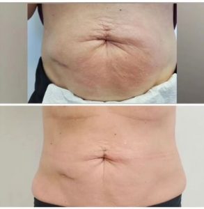 body contouring treatment for tummy
