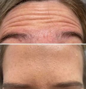 botox for forehead lines