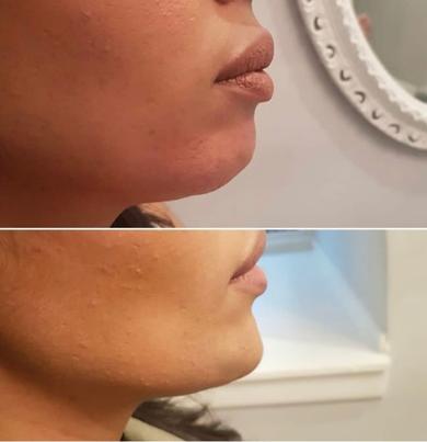 lipolysis treatment for chin fat reduction