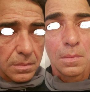 facial rejuvenation with dermal fillers