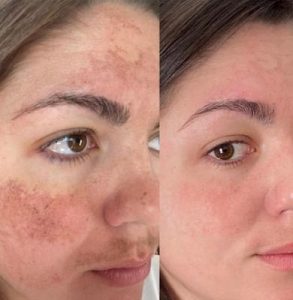 dermamelan before and after treatment