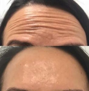forehead lines treatment with botox