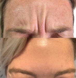 forehead lines treatment with botox