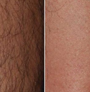 hair removal with laser
