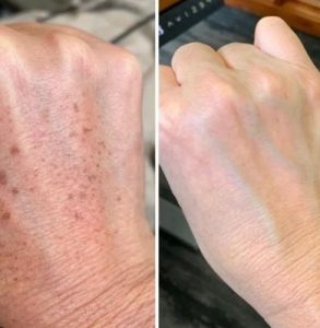 IPL treatment results for hands