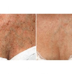 IPL treatment for chest and neck