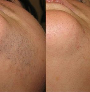laser hair removal for chin