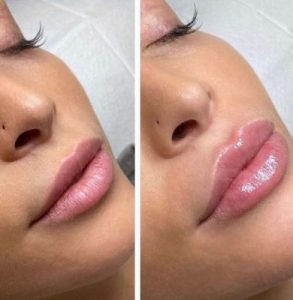 lip enhancement results