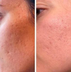microneedling before and after results