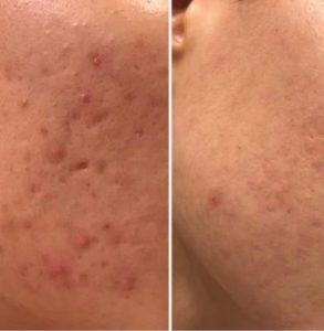 microneedling facial results