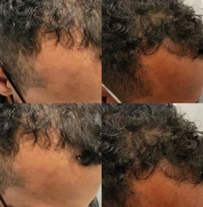 PRP hair regrowth results for men