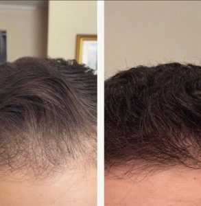 PRP hair regrowth results