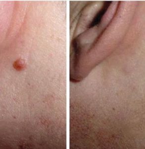 skin tag removal with freeze pen