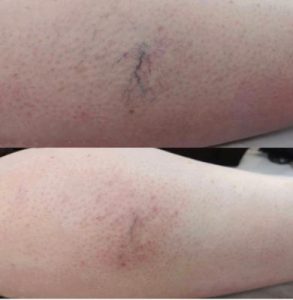 spider vein removal treatment