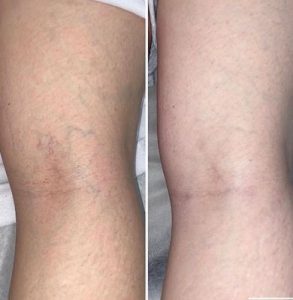 spider vein removal treatment