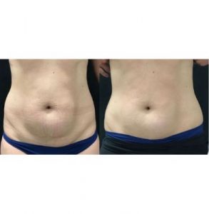 stomach contouring treatment