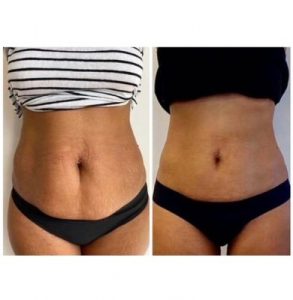 Stomach contouring