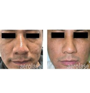 acne scar treatment for men