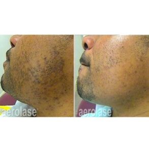 beard bumps treatment