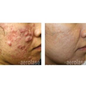 severe acne treatment solution