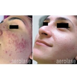 severe acne treatment