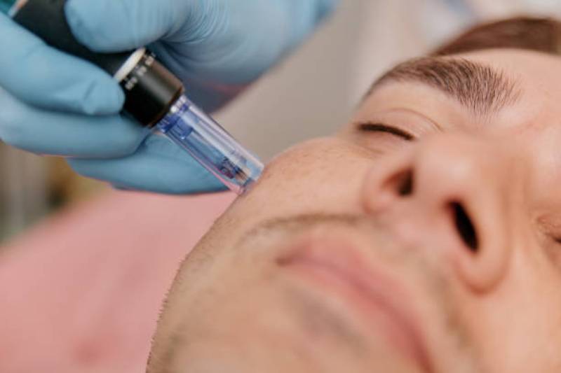 All about Microneedling