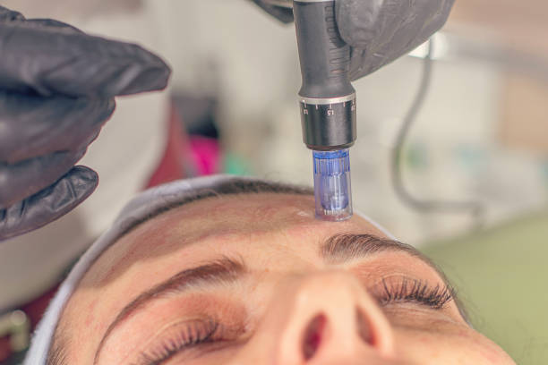 At what age should you start microneedling?