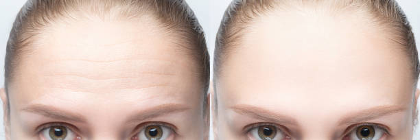 Can microneedling take the place of Botox?