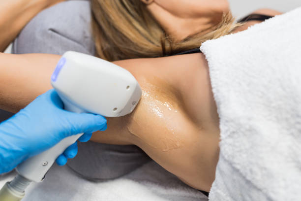 Can you go back to shaving after laser hair removal?