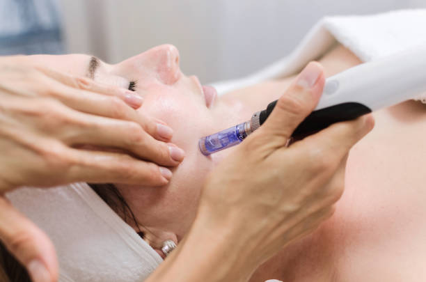 Does microneedling work forever?