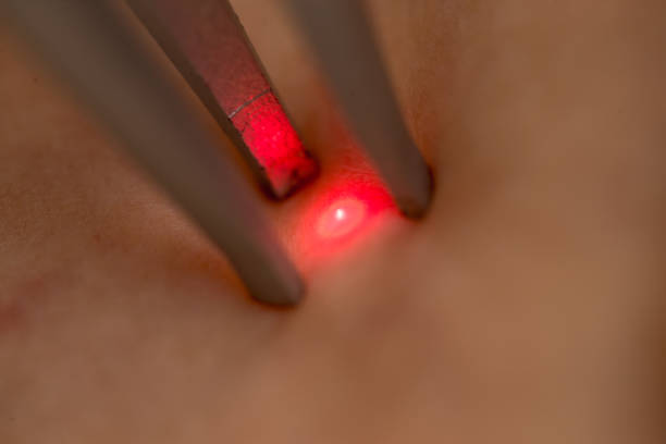 How do you know if laser hair removal is not working?