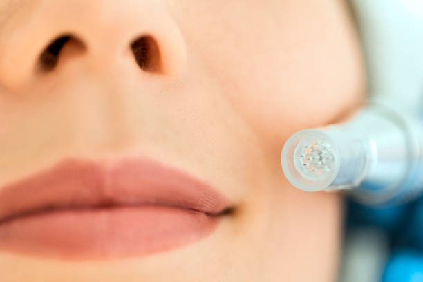 How long after microneedling can I see a difference?