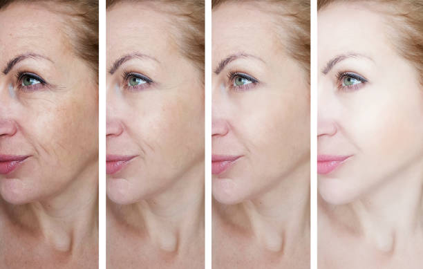 What are side effects of wrinkle fillers?