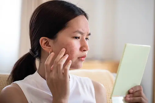 How long does acne treatment last?