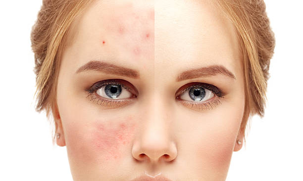 How do you know if acne treatment is working?