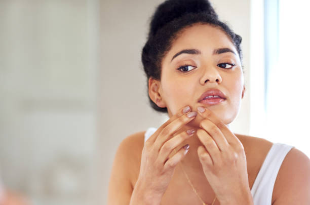 What is the most powerful acne treatment?