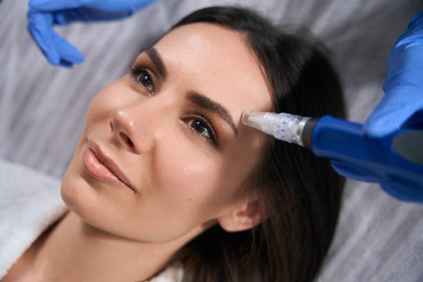 What are some interesting facts about microneedling?