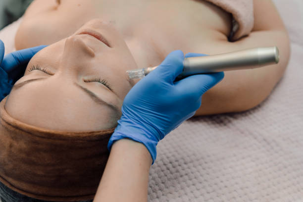 What is the best type of microneedling?