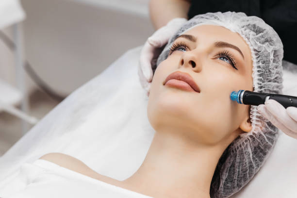 How long will my face look bad after microneedling?