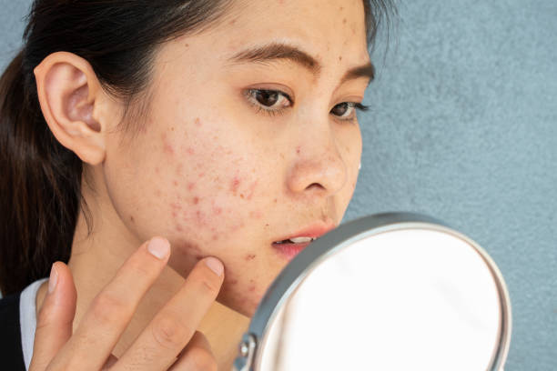 Which ingredient is best for acne?