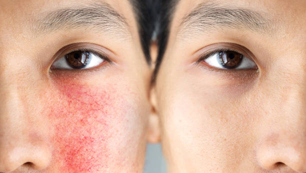 Do peels help hormonal acne?