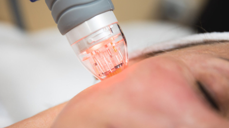 Different microneedling Toronto cost options based on treatment types. 