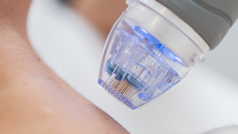 Microneedling cost Toronto clinics charge for neck treatments. 