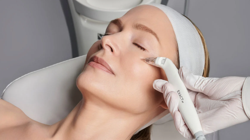 RF microneedling Toronto price affected by device technology used. 
