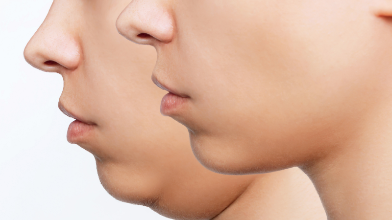 Buccal fat removal cost Toronto pricing factors. 